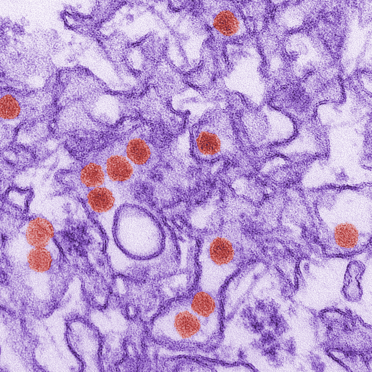 CDC Concludes Zika Virus Causes Microcephaly and Other Birth Defects