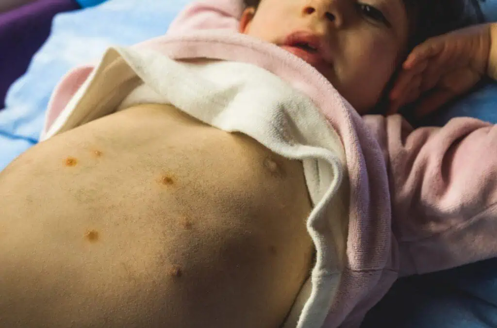 child with chicken pox