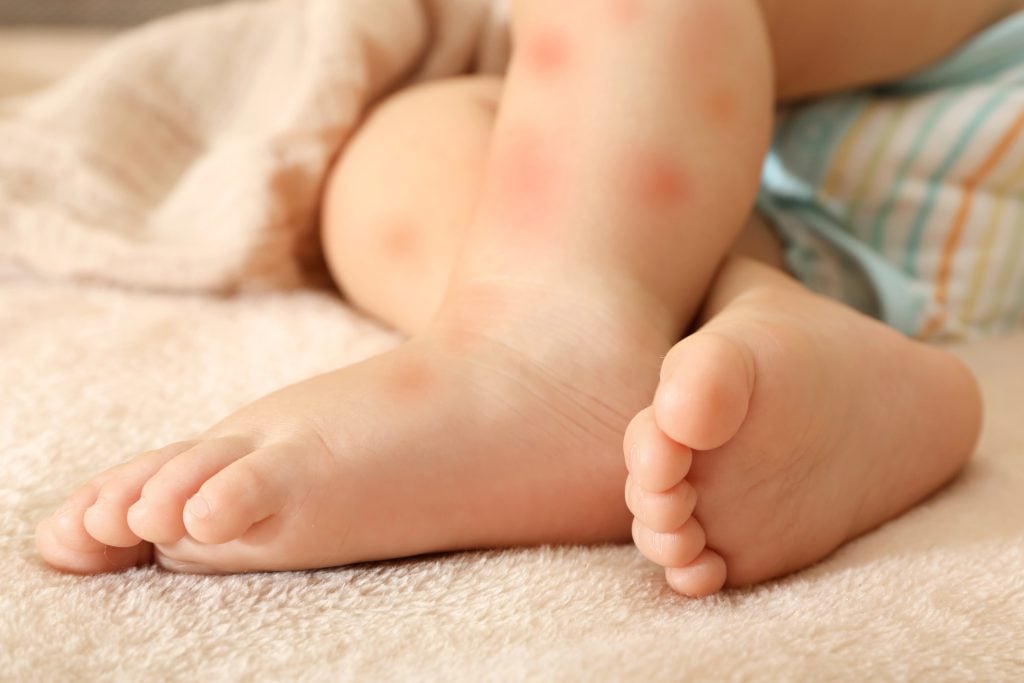 Legs of little child with red rash