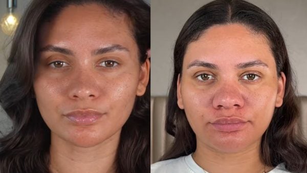 Pregnancy Can Change Everything — Even Your Face